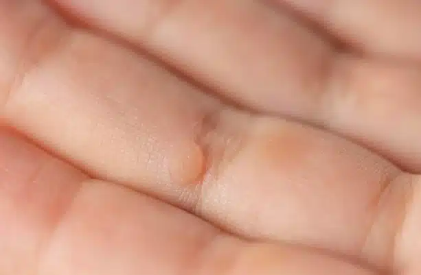 verruga en el dedo

